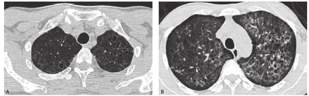 图11 肺孢子菌肺炎胸部CT表现.jpg